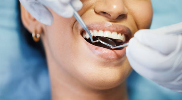 Best Urgent Care for Lost Fillings or Crowns in Daly City, CA